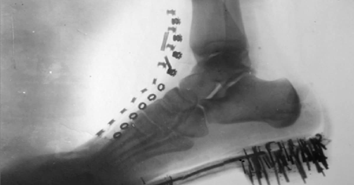 Nikola Tesla's X-Ray Foot